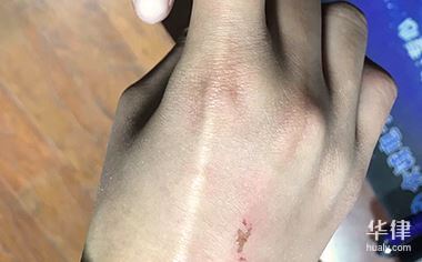 右食指末节指骨骨折工伤鉴定为几级